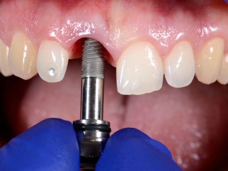 trồng răng implant yenle dental